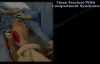 Open Fracture With Compartment Syndrome  Everything You Need To Know  Dr. Nabil Ebraheim
