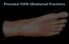 Proximal Fifth Metatarsal Fractures  Everything You Need To Know  Dr. Nabil Ebraheim