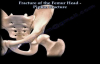 Fractures Of The Femur Head ,Pipkin Fracture  Everything You Need To Know  Dr. Nabil Ebraheim
