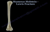 Humerus Holstein Lewis Fracture  Everything You Need To Know  Dr. Nabil Ebraheim