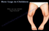 Bow Legs In Children  Everything You Need To Know  Dr. Nabil Ebraheim