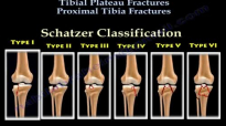 Tibial Plateau Fractures Proximal Tibia Fractures  Everything You Need To Know  Dr. Nabil Ebraheim