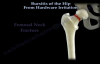 Hip Bursitis From Hardware Irritation  Everything You Need To Know  Dr. Nabil Ebraheim