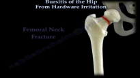 Hip Bursitis From Hardware Irritation  Everything You Need To Know  Dr. Nabil Ebraheim
