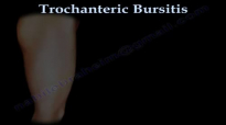 Trochanteric Bursitis , hip bursitis Everything You Need To Know  Dr. Nabil Ebraheim