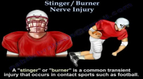 Stinger Burner Nerve Injury  Everything You Need To Know  Dr. Nabil Ebraheim