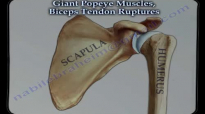 Giant Popeye Muscles Biceps Tendon Ruptures  Everything You Need To Know  Dr. Nabil Ebraheim