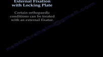 External Fixation With Locking Plate  Everything You Need To Know  Dr. Nabil Ebraheim