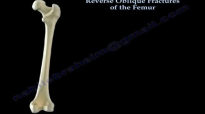 Reverse Oblique Fractures Of The Femur  Everything You Need To Know  Dr. Nabil Ebraheim