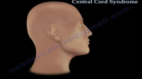 Central Cord Syndrome  Everything You Need To Know  Dr. Nabil Ebraheim