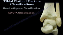 Pilon Fracture, Tibial Plafond Fracture  Everything You Need To Know  Dr. Nabil Ebraheim