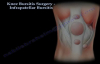 Infrapatellar Bursitis Of The Knee, Surgery  Everything You Need To Know  Dr. Nabil Ebraheim