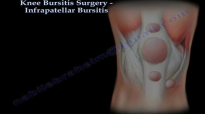 Infrapatellar Bursitis Of The Knee, Surgery  Everything You Need To Know  Dr. Nabil Ebraheim
