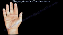 Dupuytrens Contracture  Everything You Need To Know  Dr. Nabil Ebraheim