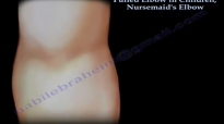 Pulled Elbow In Children, Nursemaids Elbow  Everything You Need To Know  Dr. Nabil Ebraheim