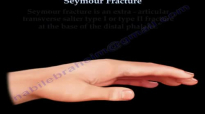 Seymour fracture base of the distal phalanx  Everything You Need To Know  Dr. Nabil Ebraheim
