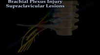 Brachial Plexus Injury, Supraclavicular Lesions  Everything You Need To Know  Dr. Nabil Ebraheim