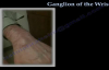 Ganglion Cyst Of The Wrist  Everything You Need To Know  Dr. Nabil Ebraheim