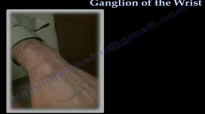 Ganglion Cyst Of The Wrist  Everything You Need To Know  Dr. Nabil Ebraheim