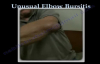 Unusual Bursitis Of The Elbow  Everything You Need To Know  Dr. Nabil Ebraheim