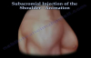 Shoulder bursitis, Tendonitis Injection Animation  Everything You Need To Know  Dr. Nabil Ebraheim