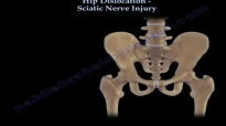 Hip Dislocation , Sciatic Nerve Injury  Everything You Need To Know  Dr. Nabil Ebraheim