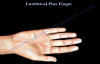 Lumbrical Plus Finger  Everything You Need To Know  Dr. Nabil Ebraheim