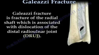 Galeazzi Fracture  Everything You Need To Know  Dr. Nabil Ebraheim