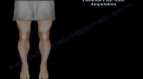 Phantom Pain Amputation  Everything You Need To Know  Dr. Nabil Ebraheim