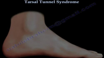 Tarsal Tunnel Syndrome  Everything You Need To Know  Dr. Nabil Ebraheim