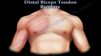 Distal Biceps Tendon Rupture  Everything You Need To Know  Dr. Nabil Ebraheim