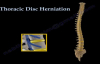 Thoracic Disc Herniation  Everything You Need To Know  Dr. Nabil Ebraheim