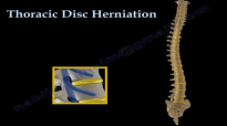 Thoracic Disc Herniation  Everything You Need To Know  Dr. Nabil Ebraheim