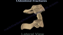 Odontoid Fractures  Everything You Need To Know  Dr. Nabil Ebraheim