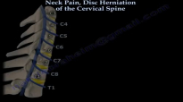 Neck Pain, Disc Herniation Of The Cervical Spine  Everything You Need To Know  Dr. Nabil Ebraheim