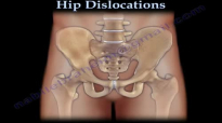 Hip Dislocations  Everything You Need To Know  Dr. Nabil Ebraheim