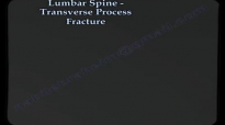 Lumbar Spine Transverse Process Fracture  Everything You Need To Know  Dr. Nabil Ebraheim