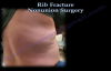Rib Fracture Nonunion Surgery  Everything You Need To Know  Dr. Nabil Ebraheim