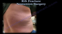 Rib Fracture Nonunion Surgery  Everything You Need To Know  Dr. Nabil Ebraheim