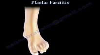Plantar Fasciitis  Everything You Need To Know  Dr. Nabil Ebraheim