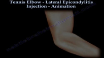 Tennis Elbow Lateral Epicondylitis Injection  Everything You Need To Know  Dr. Nabil Ebraheim