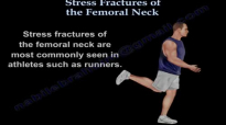 Stress Fractures Of The Femoral Neck  Everything You Need To Know  Dr. Nabil Ebraheim