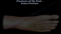 Jones Fracture,proximal fifth metatarsal  Everything You Need To Know  Dr. Nabil Ebraheim