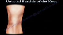 Unusual Bursitis Of The Knee  Everything You Need To Know  Dr. Nabil Ebraheim