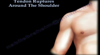 Tendon Ruptures Around The Shoulder  Everything You Need To Know  Dr. Nabil Ebraheim