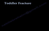 Toddler Fracture , tibial fracture in a child Everything You Need To Know  Dr. Nabil Ebraheim