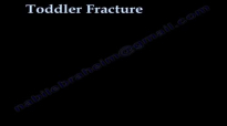 Toddler Fracture , tibial fracture in a child Everything You Need To Know  Dr. Nabil Ebraheim