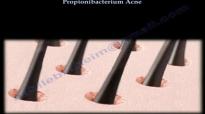 Acne explained ,Propionibacterium Acne  Everything You Need To Know  Dr. Nabil Ebraheim
