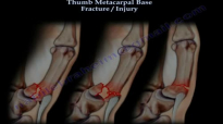Thumb Metacarpal Base Fracture Injury  Everything You Need To Know  Dr. Nabil Ebraheim