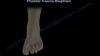 Plantar Fascia Rupture  Everything You Need To Know  Dr. Nabil Ebraheim